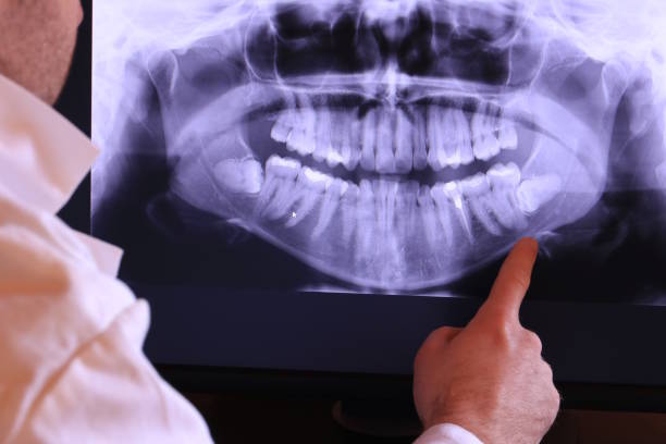 Best Emergency Treatment for Dental Infections or Abscesses in Bret Harte, CA