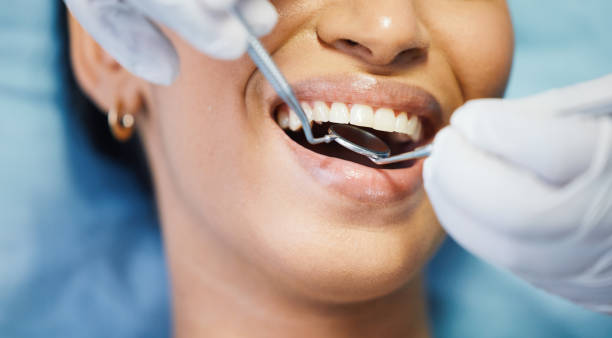 Best Urgent Care for Lost Fillings or Crowns in Bret Harte, CA