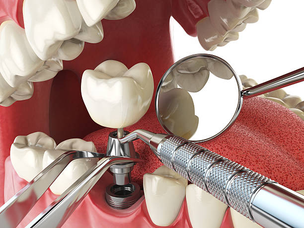 Best Emergency Dental Care for Broken or Chipped Teeth in Bret Harte, CA